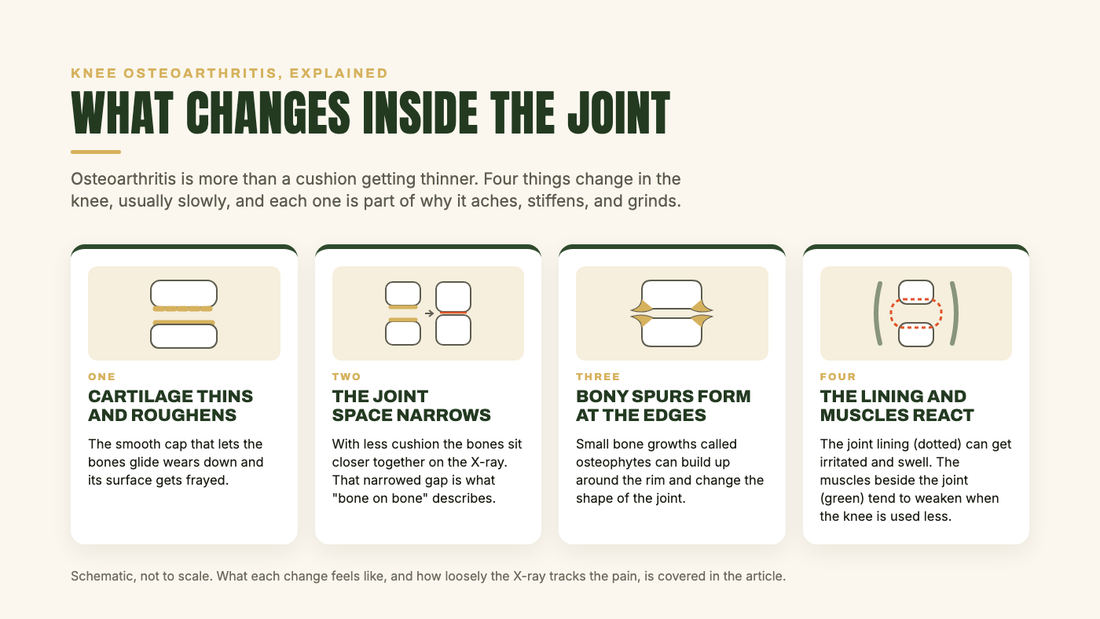 Diagram of the four changes inside a knee with osteoarthritis: cartilage thins and roughens, the joint space narrows, bony spurs form at the edges, and the joint lining and surrounding muscles react