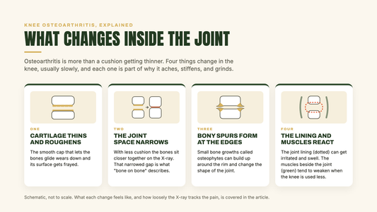 Diagram of the four changes inside a knee with osteoarthritis: cartilage thins and roughens, the joint space narrows, bony spurs form at the edges, and the joint lining and surrounding muscles react